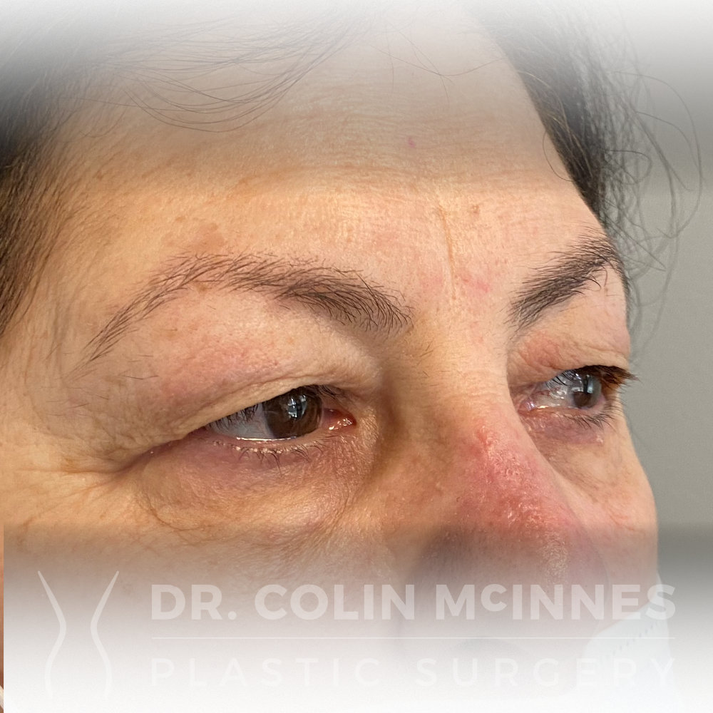 Upper Eyelid Blepharoplasty - BEFORE