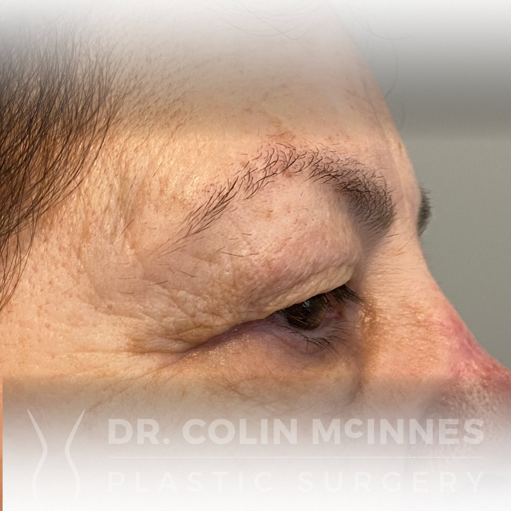 Upper Eyelid Blepharoplasty - BEFORE