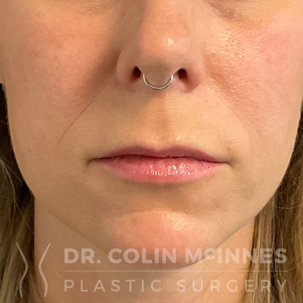 Upper Lip Lift - BEFORE