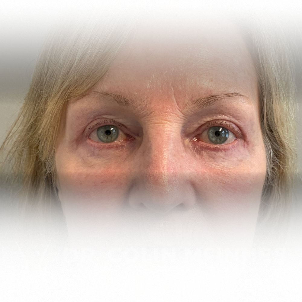 Upper & Lower Eyelid Blepharosplasty - AFTER (2.5 MONTHS)