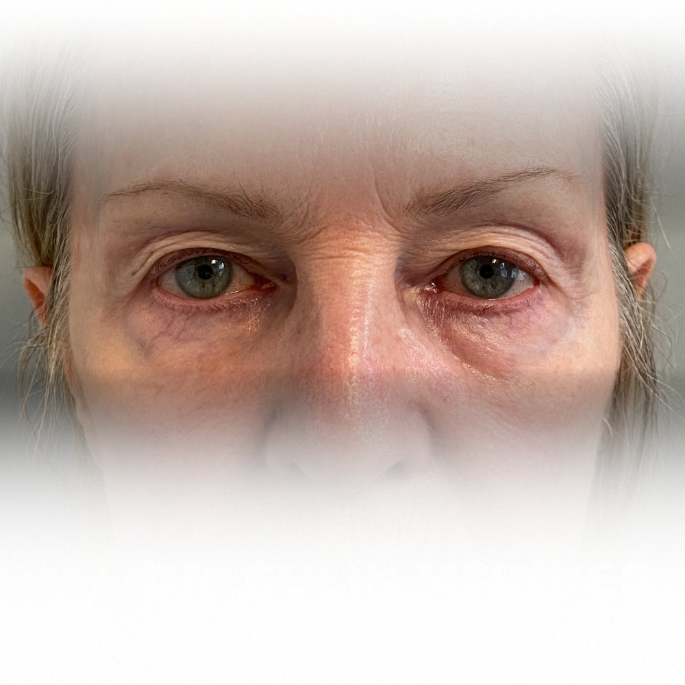 Upper & Lower Eyelid Blepharosplasty - BEFORE