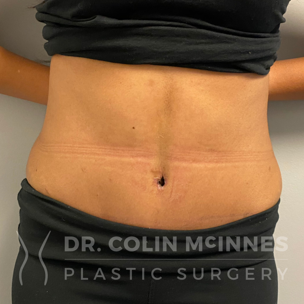 Drainless Abdominoplasty with Liposuction - 2 WEEKS POST-OP