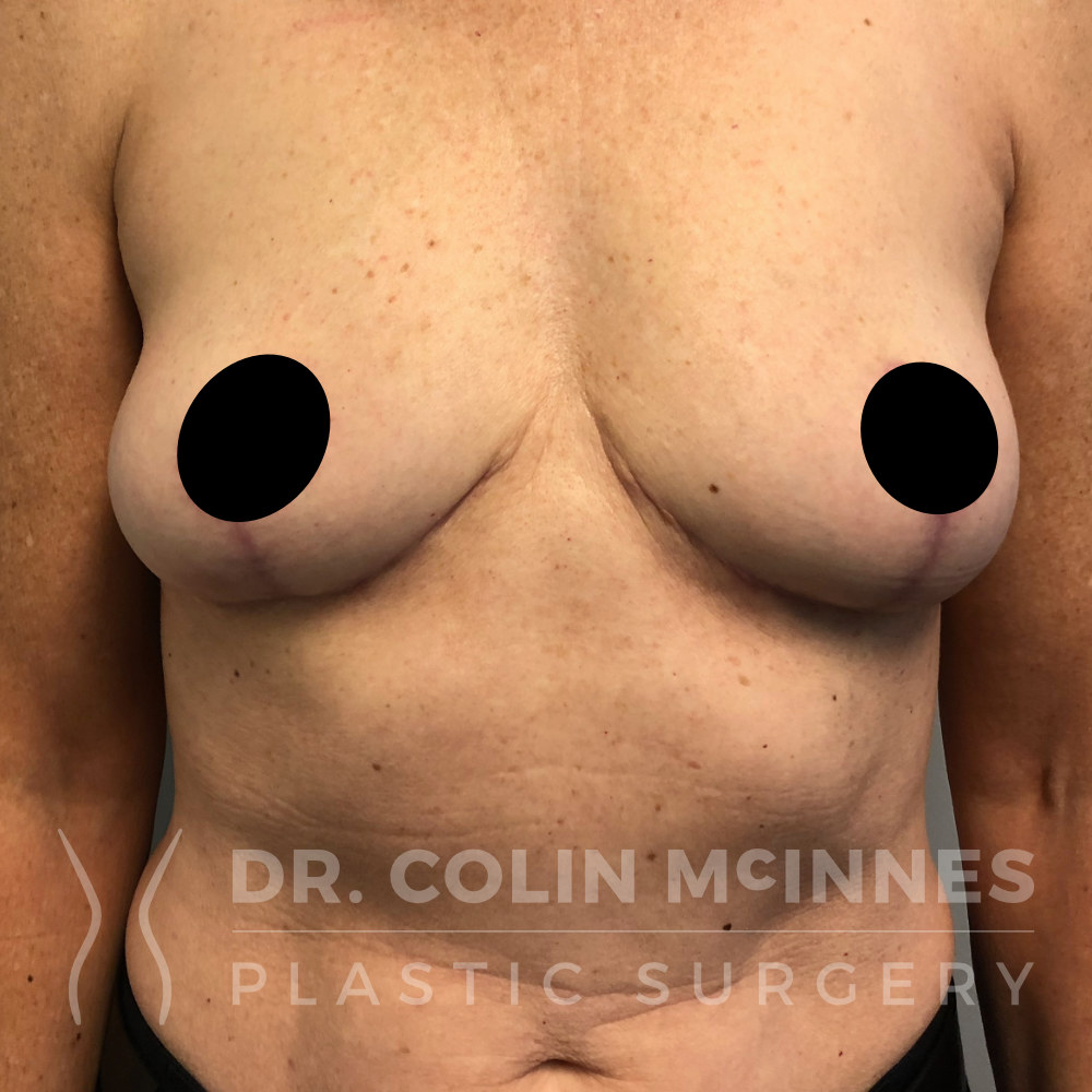 En-Bloc Explant with Immediate Breast Lift - 4 MONTHS POST OP