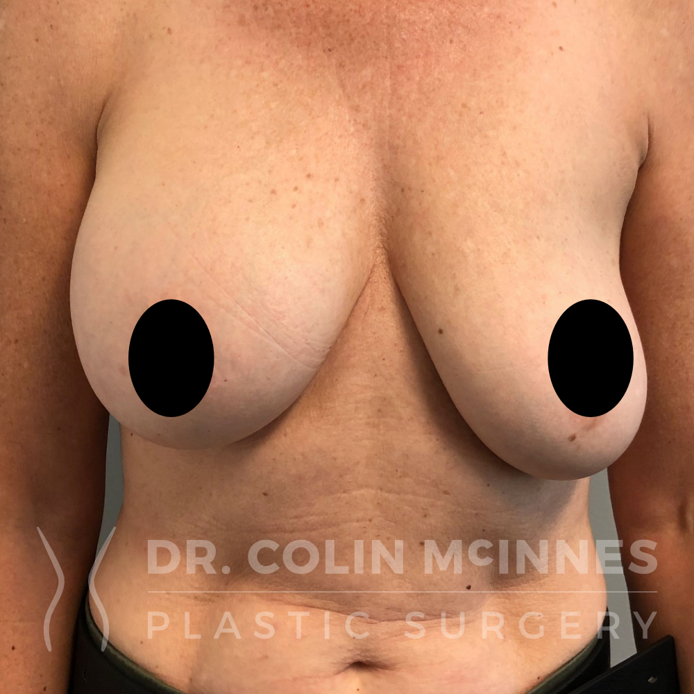 Implant Removal / Capsulectomy and Immediate Lift - BEFORE